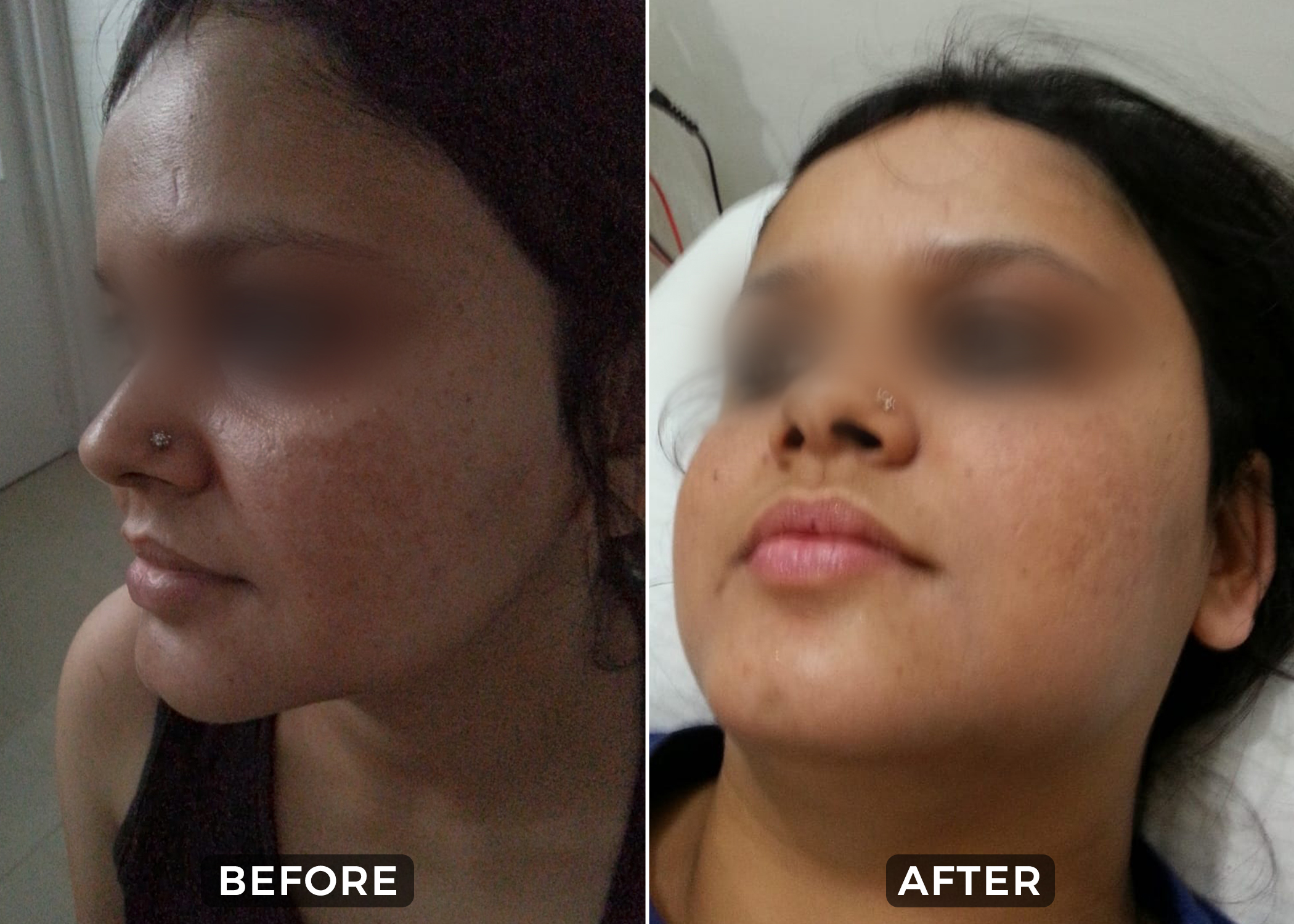 laser hair removal-before & after