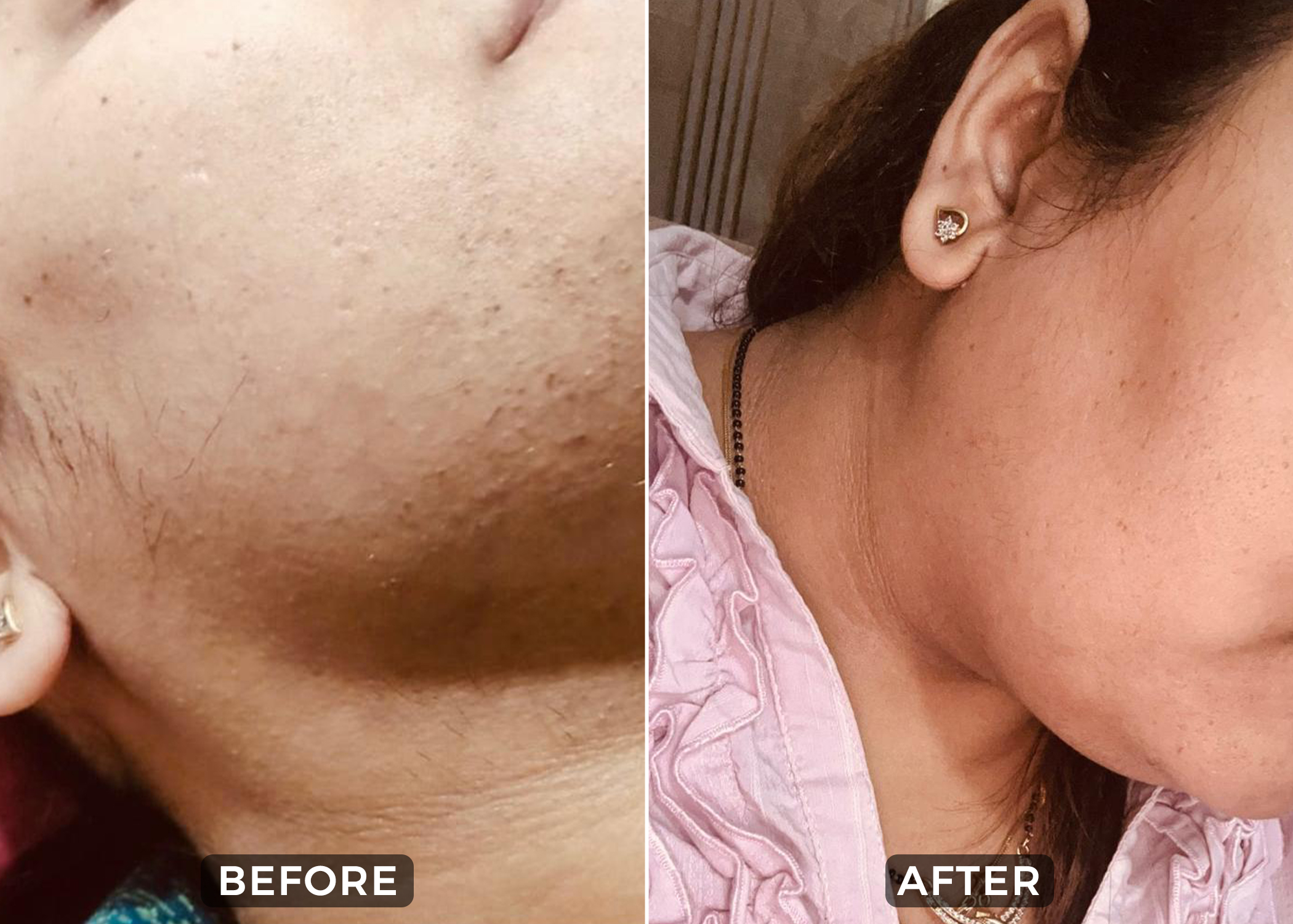 laser hair removal-before & after